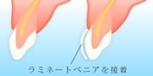 ラミネートベニア