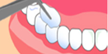フッ素塗布